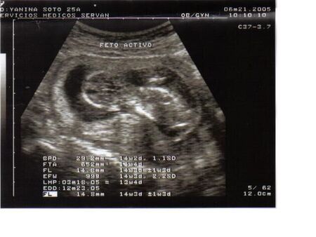 ES LA PRIMERA FOTO DE MI FUTURO BEBE
MIGUEL ANGEL CERRON DURAND
06 Aug 2005