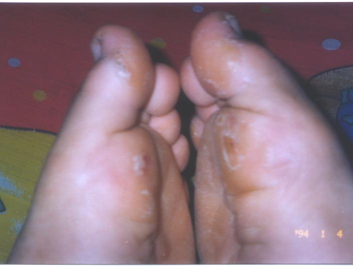 Kalyo I developed in my last area ( sorry guys it's kinda grose)
George Ordonez Lim
18 May 2006